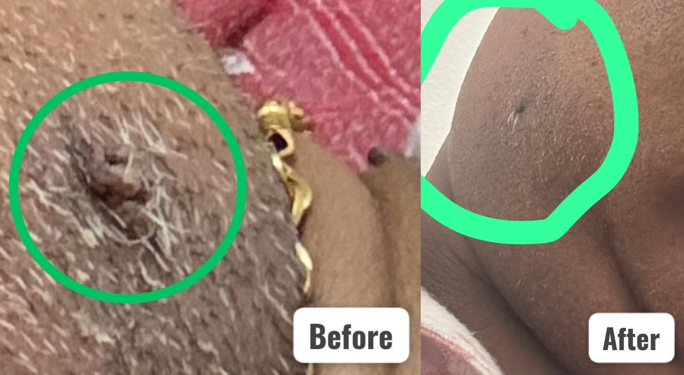 Before and after of a patient treated for Wart Treatment